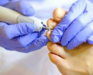 pedicure-medicale-luxembourg-dudelange-ongle-casse