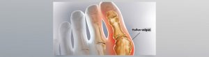 oignon-pied-pedicure-luxembourg-soigner-podologue